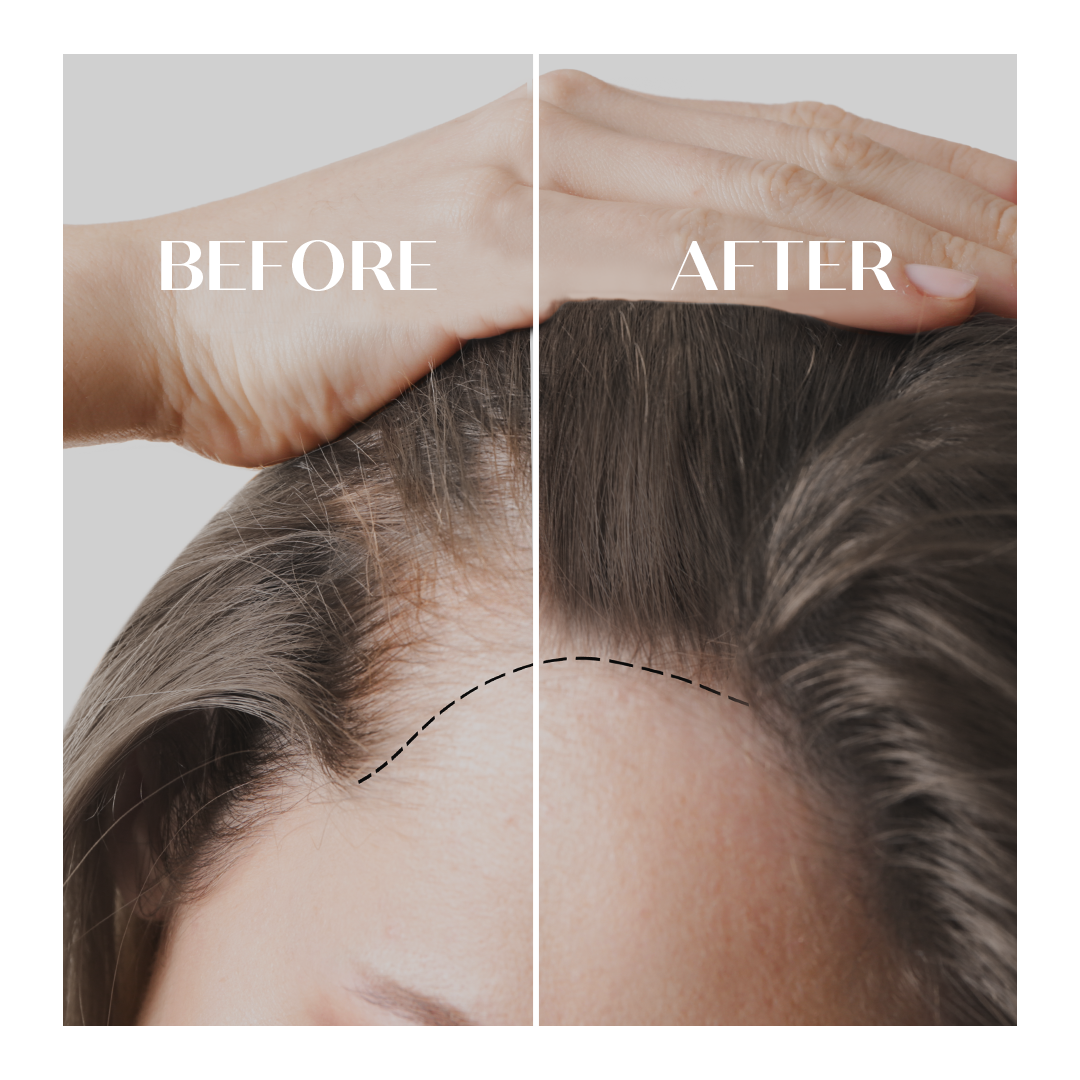 RIBESKIN Blog How to build a hair loss treatment program for your clinic?