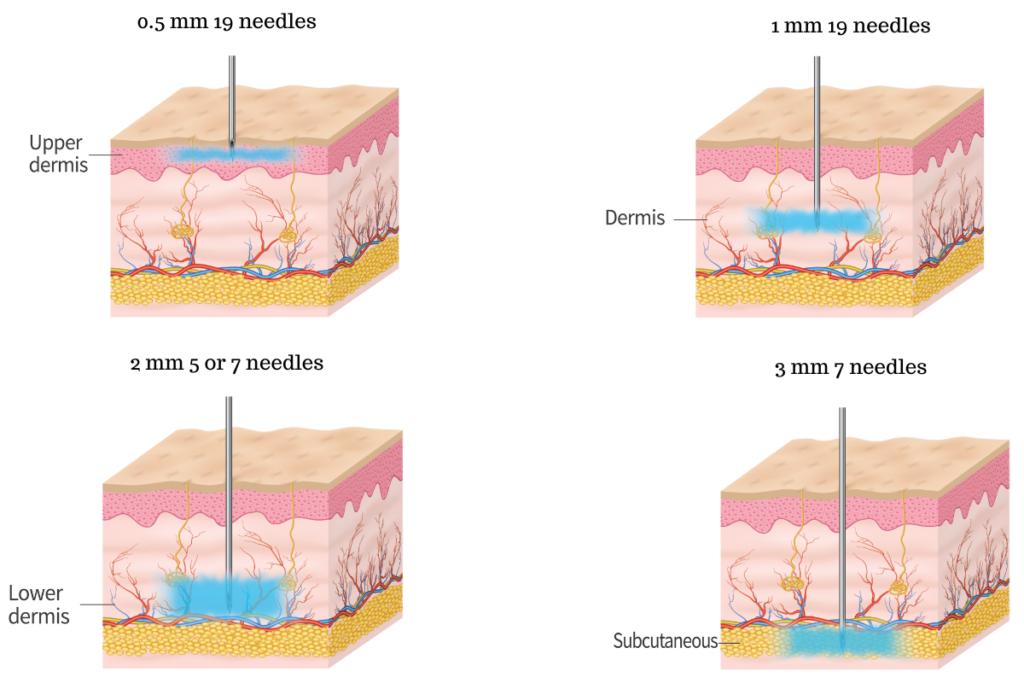 a diagram depicting the various depths of skin which turtlepin can cover
