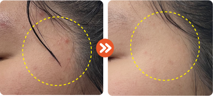 acne improvement on face after using RIBESKIN Dr MAL in PDT treatment
