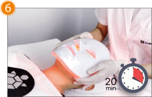 LED light therapy performed during pdt treatment with dr mal solution for acne treatment