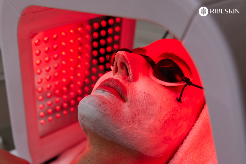 LED facial device being used for PDT therapy for acne treatment