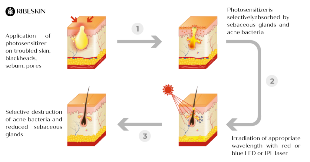 Process of PDT procedure for acne treatment