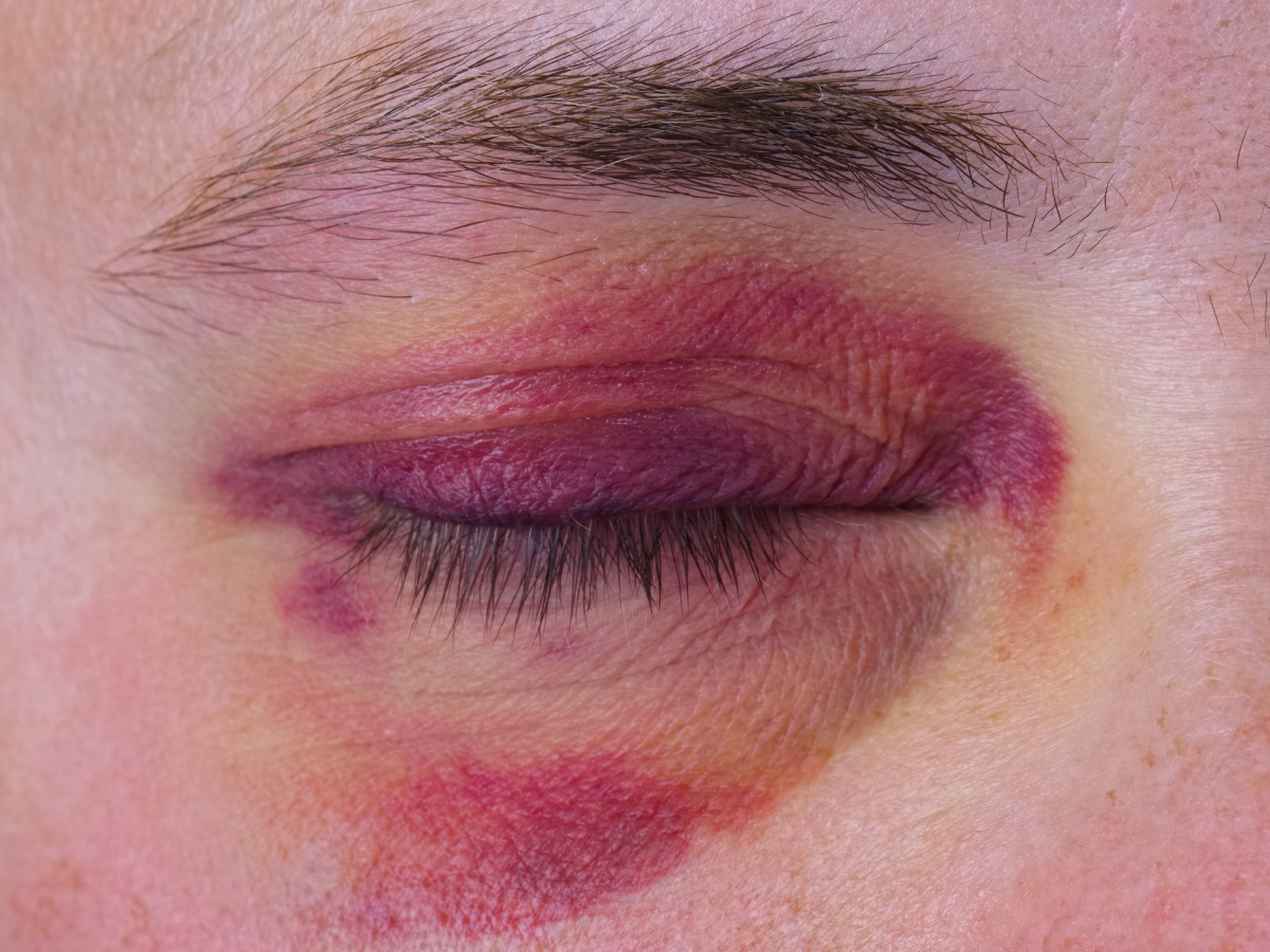 bruise around eyes after plastic surgery