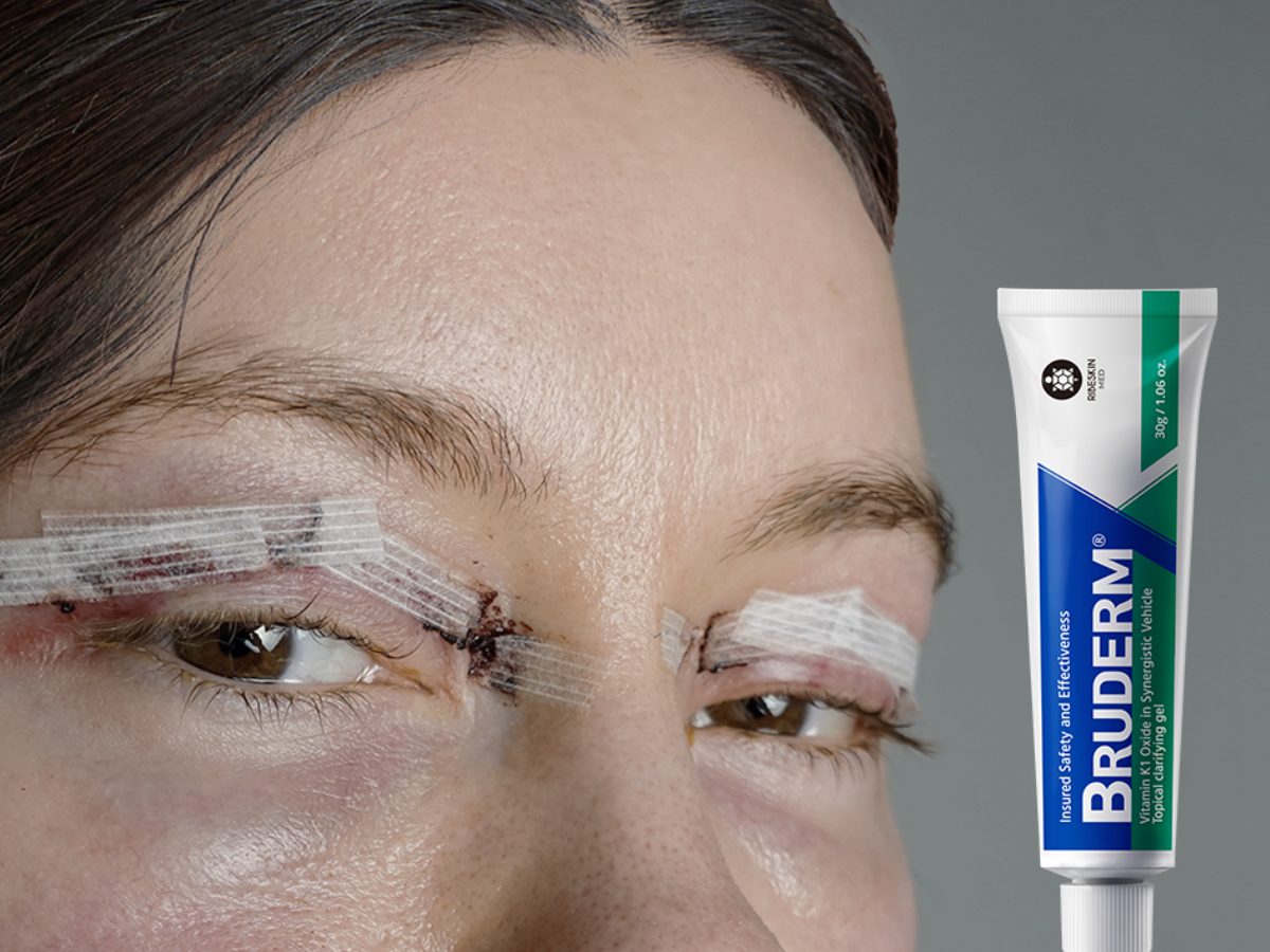 girl with stitches on eyes after plastic surgery; with a tube of bruderm cream