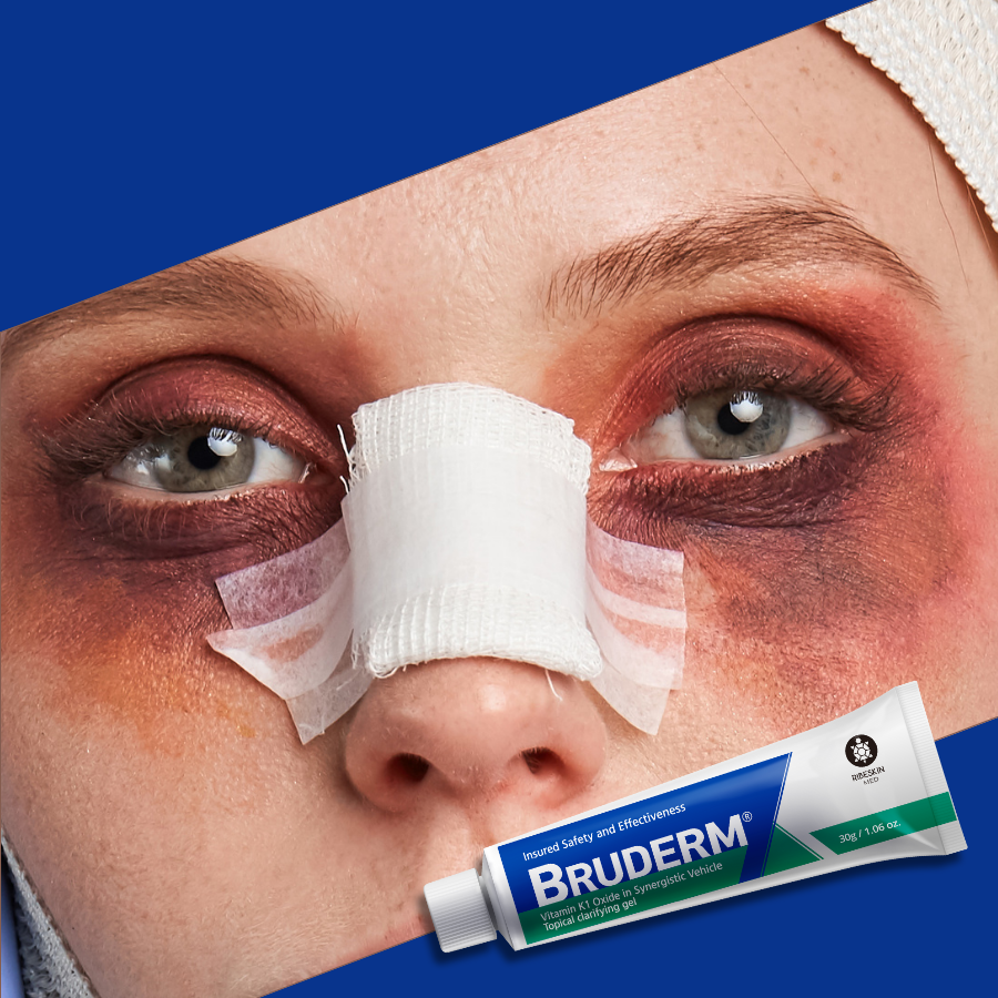 a girl with bruises around her eyes and nose after plastic surgery; and bruderm cream