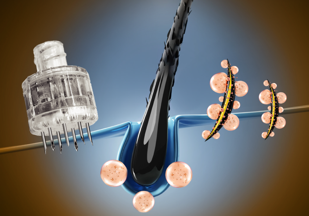 RIBESKIN Hairlopecia Meso Complex hair loss treatment with spicules