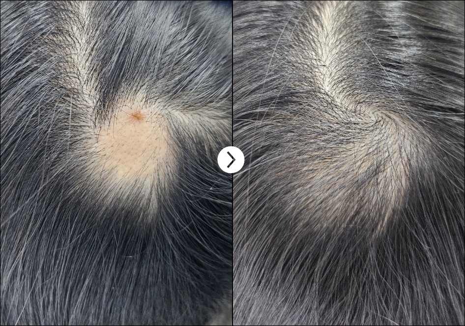 RIBESKIN Hairlopecia Meso Complex before and after treatment image