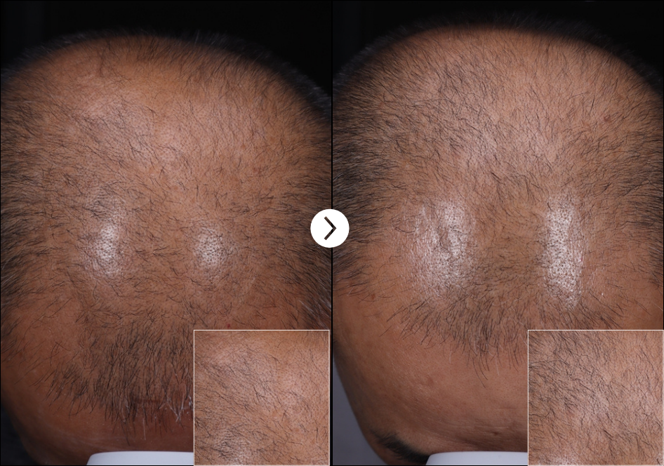 RIBESKIN Hairlopecia Meso Complex before and after treatment image