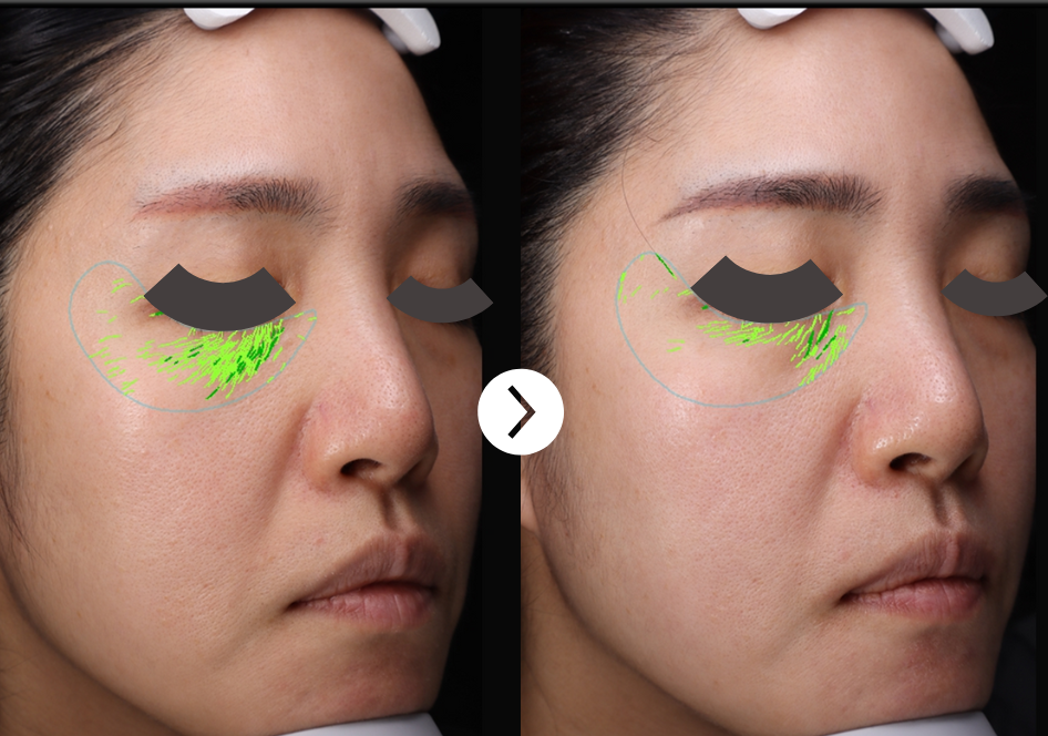 Clinical results of wrinkle reduction after RIBESKIN betterfill56+ exosome treatment