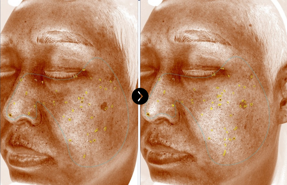 Clinical results of reduction in Epidermal Pigmentation after RIBESKIN betterfill EXO56+ exosome treatment
