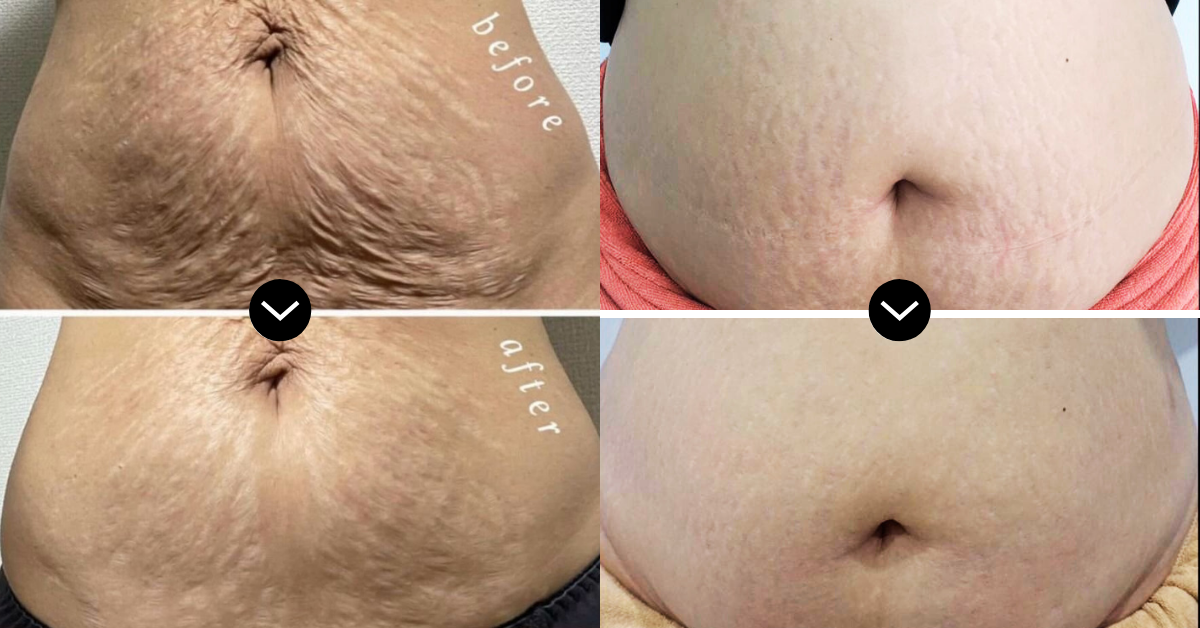 Stretch mark reduction on abdomen after RIBESKIN CO2 Carboxy Therapy