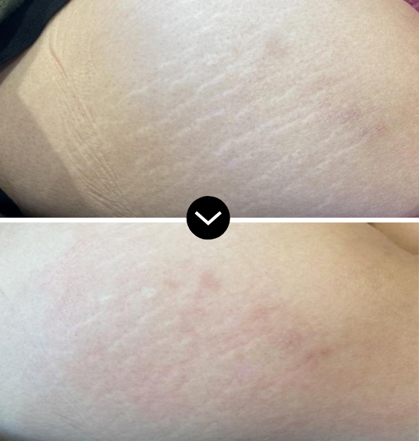 Stretch mark reduction on buttocks after RIBESKIN CO2 Carboxy Therapy