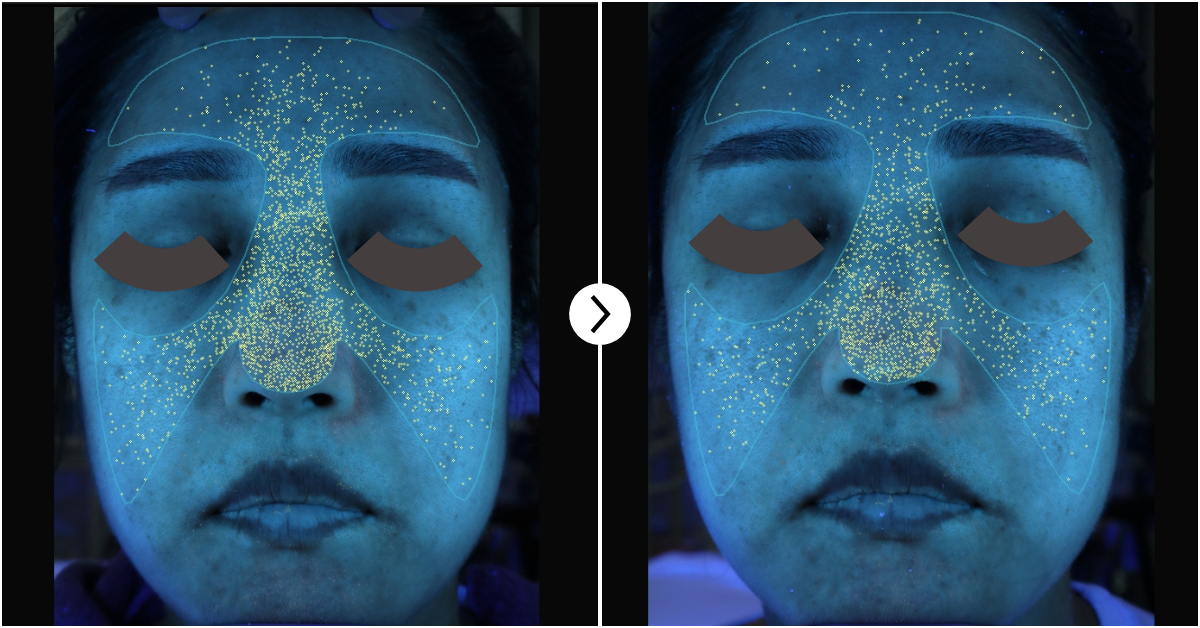 29.48% Reduction in porphyrin (acne causing bacteria) after RIBESKIN CO2 Carboxy Therapy