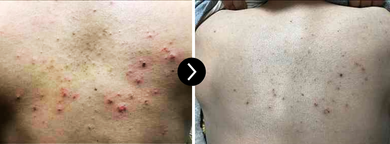 Back acne reduction after CO2 Carboxy Therapy