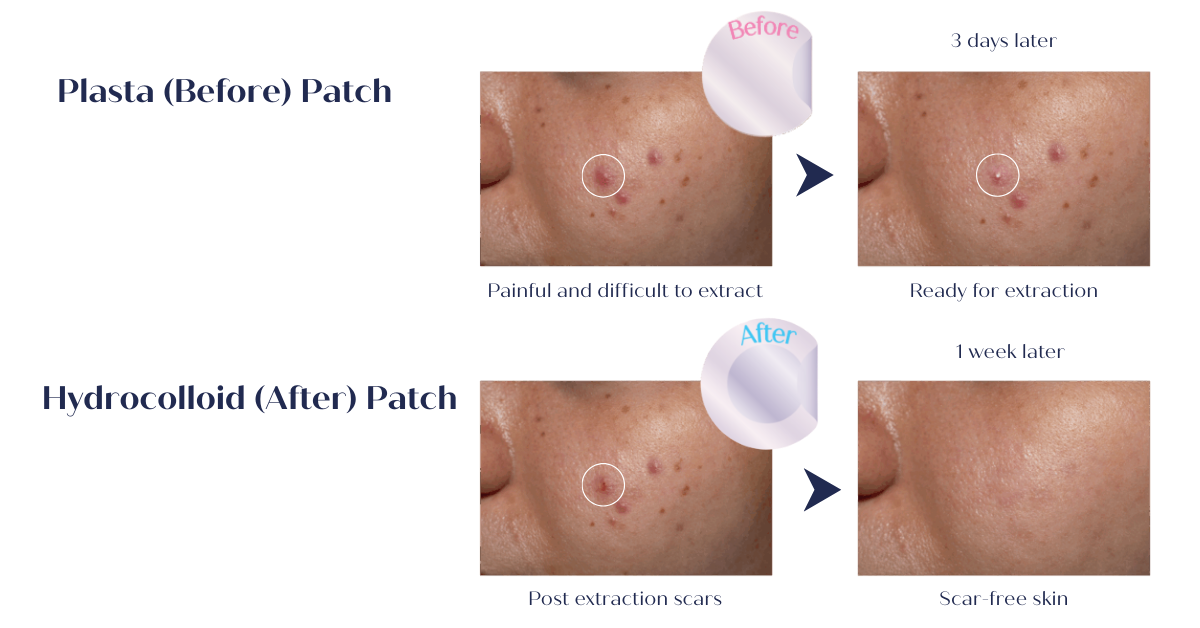 RIBESKIN SOS Spot Patch acne pimple patches used in Korean dermatology clinics