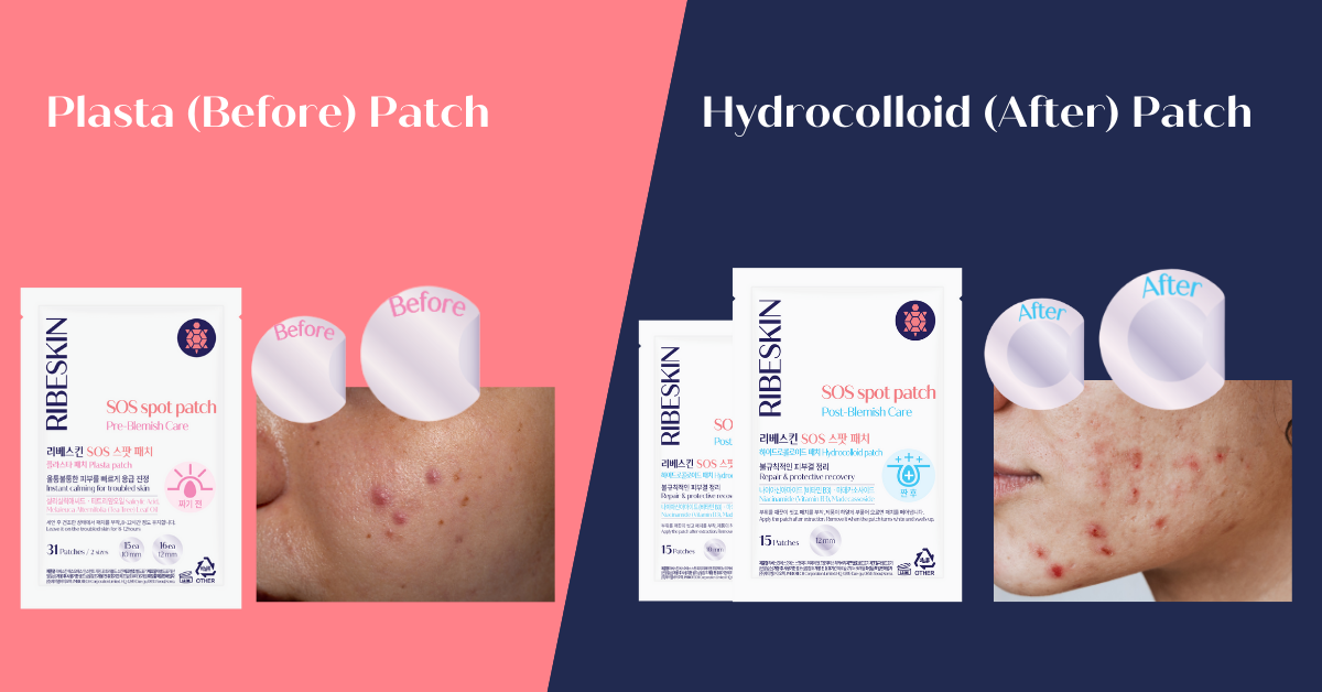 RIBESKIN SOS Spot Patch acne pimple patches used in Korean dermatology clinics